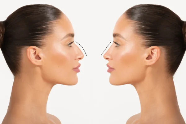 Surgical-rhinoplasty-vs-non-surgical-nose-job