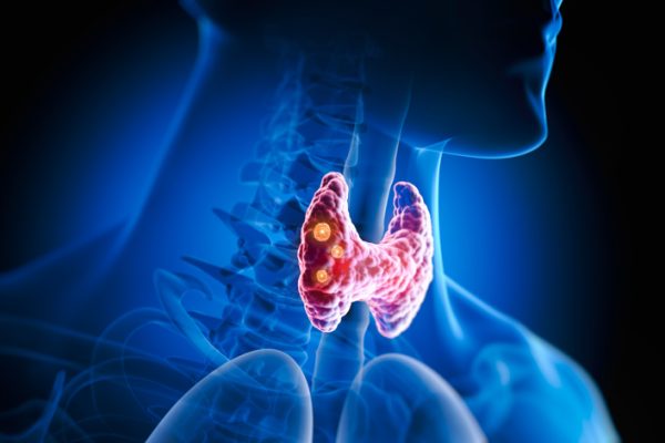 Thyroid gland with nodules inside human body - 3D illustration